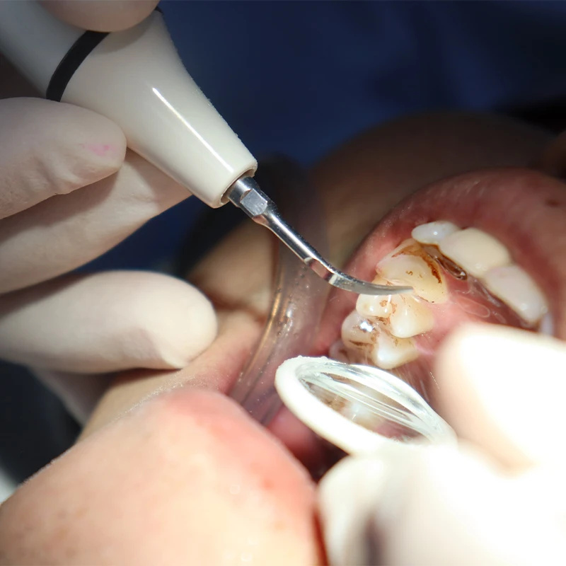 Scaler Handpiece Tube Cable fo - Teeth Whitening Youtube 评论和价格