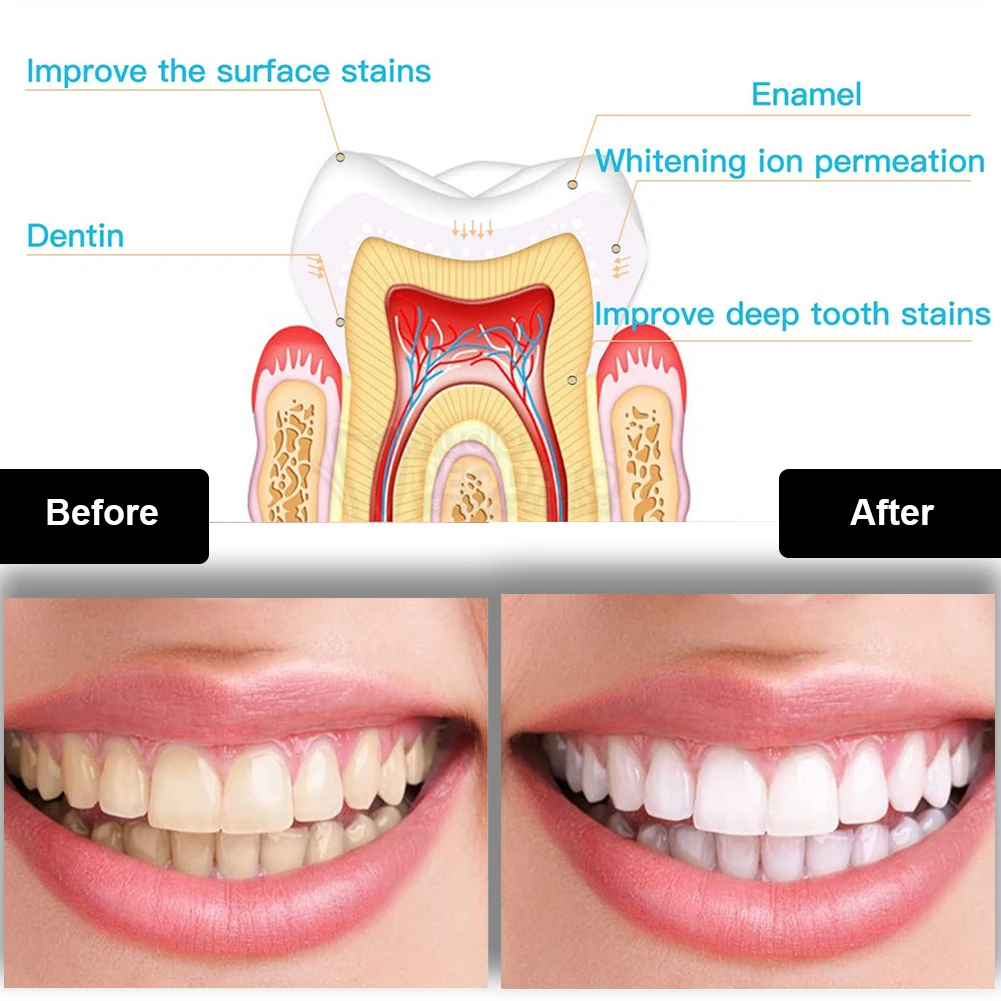 Dental Teeth Whitening Kit Min - Teeth Whitening Hydrogen Peroxide 评论和价格